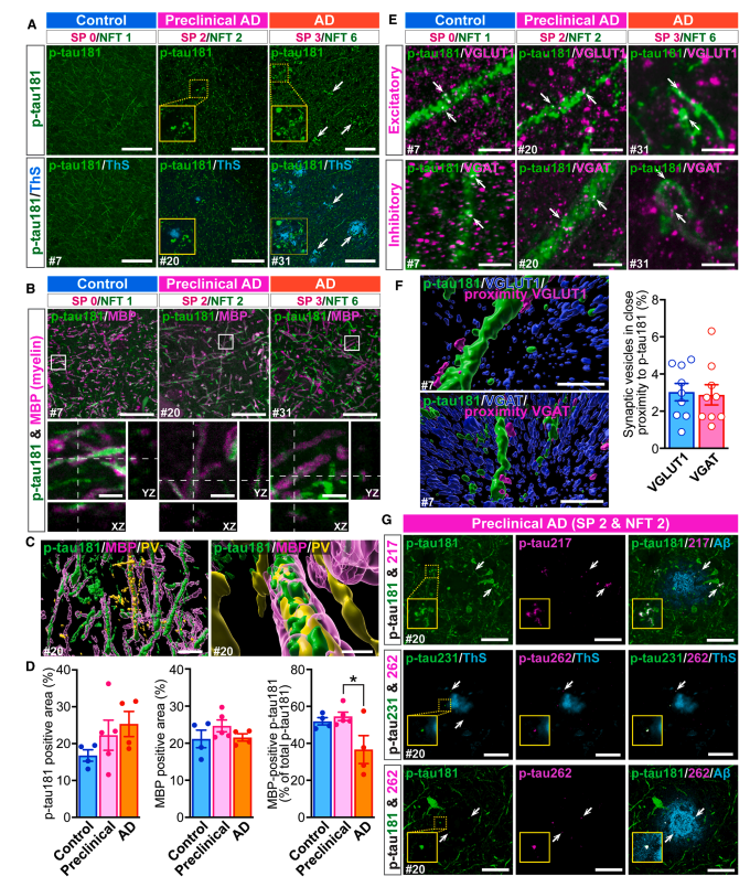 Figure 3: p-tau181 in axons